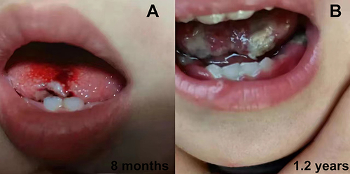 Figure 1 SRFMM tongue ulcer in patient 2. (A) shows a small ulcer at 8 months of age. (B) shows multiple ulcers at 1.2 year of age.