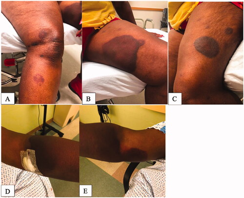 Figure 1. Presentation at diagnosis. (A) Right lower extremity. (B) Left lower extremity (medial thigh). (C) Left lower extremity (outer thigh). (D) Left upper extremity. (E) Right upper extremity.