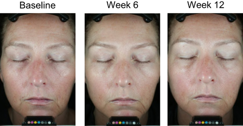 Figure 7 Improvements in appearance of photodamaged skin after 6 and 12 weeks of DGR. The participant pictured was a 48-year-old woman with Fitzpatrick Skin Type I, under parallel-polarized lighting.