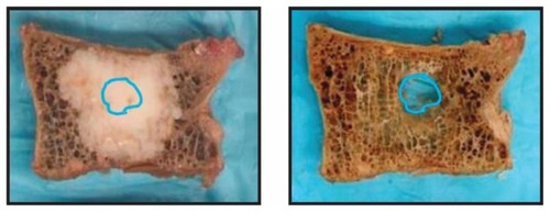Figure 5 Radiofrequency-targeted vertebral augmentation sectioned specimen demonstrates a greater depth of cement interdigitation beyond the surgically created cavity (left) and less trauma to native trabeculae and a cavity that consumes a smaller percentage of the vertebral body after polymethylmethacrylate dissolution (right).