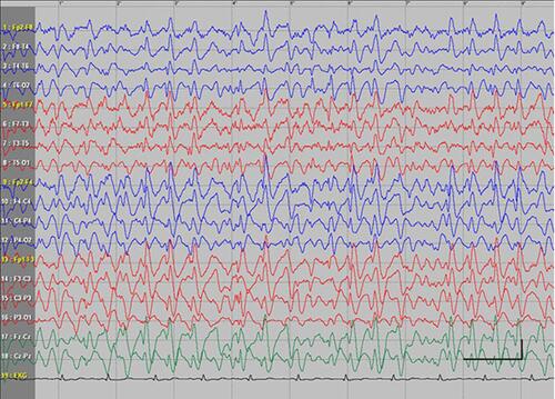 Figure 1 Absence status epilepticus in patient 6. Vertical bar - 100uV, horizontal bar- 1 sec.