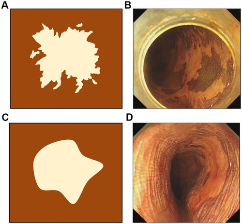 Figure 1 Images of esophageal squamous epithelial neoplastic lesions after iodine staining. (A) A schematic drawing of the worm-eaten boundary of an iodine-unstained area (irregular type). (B) A lesion with an irregular type of boundary of an iodine-unstained area. (C) A schematic drawing of the smooth boundary of an iodine-unstained area (regular type). (D) A lesion with a regular type and a well-demarcated boundary of an iodine-unstained area.
