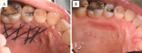 Figure 7 Reepithelialization of the palate 14 days after HAM grafting, before (A) and after (B) removal of stitches.