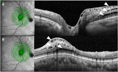 Figure 1 An OCT image showing PRS. (A) Infrared image of the optic nerve showing the location of the B-scan and extent of the PRS (left). OCT demonstrates PRS in the RNFL, GCL, and OPL (white arrowhead) (right). (B) Infrared image of the optic nerve showing the location of circle scan analysis. Two-dimensional analysis of the area 3.5 mm from the ONH. PRS is present in the RNFL, GCL, and OPL (arrowhead).