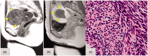 Figure 2. (a) T2-weighted magnetic resonance imaging (MRI) of a cellular leiomyoma (triangle) before transcervical microwave myolysis (TCMM). (b) Gadolinium-enhanced T1-weighted MRI of a cellular leiomyoma one month after TCMM & microwave endometrial ablation. The necrotic changes of the cellular leiomyoma are depicted as a de novo avascular area (triangle). The leiomyoma had shrunk from 5.6 cm to 3.4 cm in size. (c) Histological findings of a cellular leiomyoma on needle biopsy before TCMM. Stained with hematoxylin and eosin. Magnification ×200.