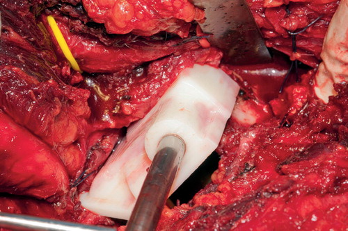 Figure 3. Intraoperative photograph showing the custom osteotomy guide on the patient’s pelvis.
