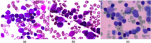 Figure 1 Morphology and cytochemistry of peripheral and bone marrow smear of tumor cells. Basophilic precursors with medium-size, round nucleus and moderately basophilic cytoplasm containing a variable number of coarse basophilic granules (a). Marrow smear showed these atypical basophils were positive for toluidine blue (b) and negative for peroxidase (c).
