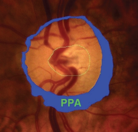 Figure 5 Peripapillary atrophy (PPA).