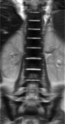 Figure 5 Coronal T2W image of the spine shows very low signal intensity of the bone marrow that is specific for ECD.