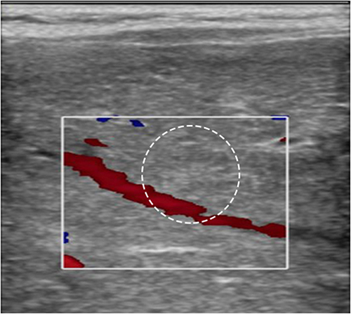 Figure 8 The internal blood flow signal disappeared after 4 months of treatment. The white circle indicates the location of the hepatic hemangioma.