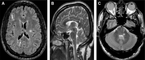 Figure 2 Brain MRI of Case no 14.