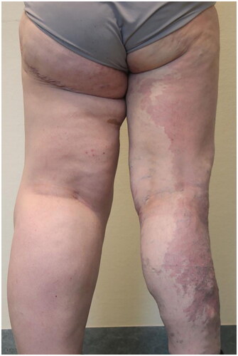 Figure 3. Standing posterior view of the patient after liposuction and tissue removal surgeries.