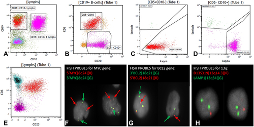 Figure 4 Peripheral Blood Flow Cytometry and FISH Testing for Case #2. For case #2, ancillary studies were performed on the peripheral blood as the bone marrow was a dry tap. Flow cytometry analysis identified two distinct B-cell populations (A–E). One B-cell population (red color) expressed CD19, CD5, and CD23 but was negative for CD10. The second B-cell population (pink color) was positive for CD10 but negative for CD5 and CD23. Both populations showed kappa light chain restriction (C and D). FISH break-apart probes showed MYC gene rearrangement and BCL2 gene rearrangement (F and G, green and red arrows indicate break apart signals) and identified deletion of 13q14.3 (H).