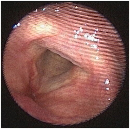 Figure 3. Fiberoptic laryngoscopic image of the vocal cords 1 week postoperatively.