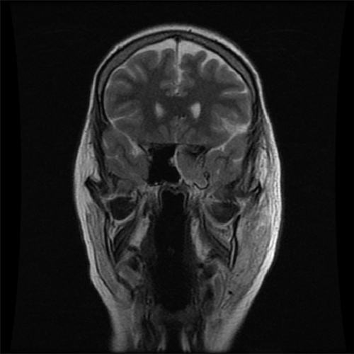 Figure 2 MRI showed cavernous sinus thrombosis.