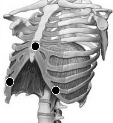 Figure 2 Positioning of the electrodes (black circles) for the acquisition of EMGdi.