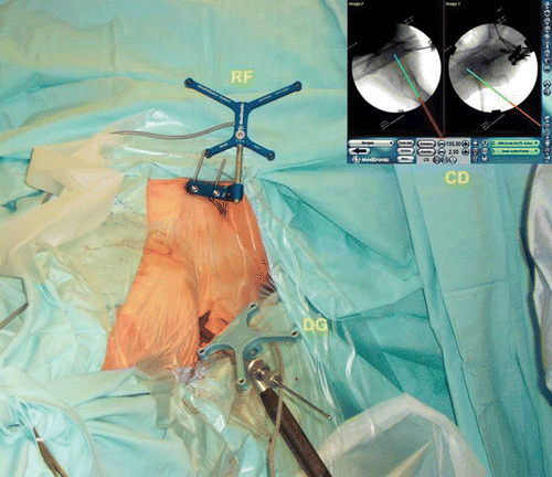 Figure 1. Standard fluoroscopic-based navigation for cannulated screw insertion. The dynamic reference frame (labeled RF) is attached to the iliac crest. A tracked drill guide (DG) is used for planning the screw's trajectory, and a guide wire is than inserted through it. The computer display (CD) displays the virtual image of the drill guide trajectory (green line) on both the AP and lateral views simultaneously. [Color version available online.]