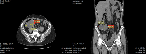 Figure 5. CT scan before surgery. Arrows indicates the hypodense formation, retrocecal in the right iliac fossa, 8.5 × 5 cm on the axial plane, with fine solid sedimentations and parietal calcifications without significant impregnation after use of the contrast medium.