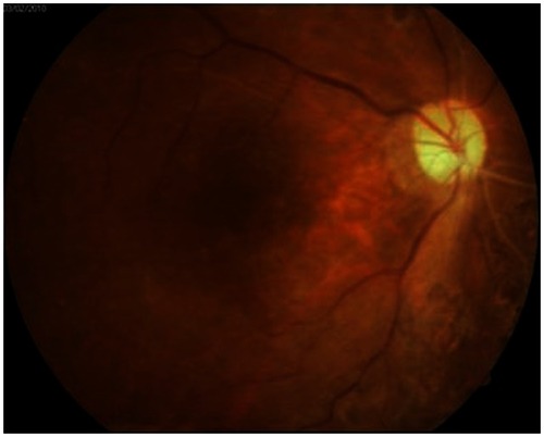 Figure 3 Fundus photography after silicone oil removal. A well-attached retina was observed.