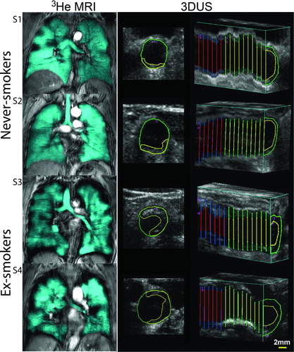 Figure 1.  Representative 3He MRI and 3DUS images for two never-smokers (S1 and S2) and two ex-smokers (S3 and S4). Never-smoker S1 is a 67-year-old female with FEV1 = 120%, FEV1/FVC = 0.77, 3He MRI VDP = 3%, TPV = 20 mm3 and IMT = 0.79 mm. Never-smoker S2 is a 68-year-old male with FEV1= 93%, FEV1/FVC = 0.79, 3He MRI VDP = 2%, TPV = 30 mm3 and IMT = 0.73 mm. Ex-smoker S3 is a 79-year-old female with FEV1 = 88%, FEV1/FVC = 0.71, VDP = 8%, TPV = 500 mm3 and IMT = 0.94 mm. Ex-smoker S4 is a 85-year-old male with FEV1 = 139%, FEV1/FVC = 0.79, VDP = 8%, TPV = 340 mm3 and IMT = 0.96 mm. The axial 3DUS image of the common carotid artery shows the intima-lumen boundary in green and carotid plaque-lumen boundary in yellow. The longitudinal 3DUS carotid image shows IMT segmentation of the common carotid artery.