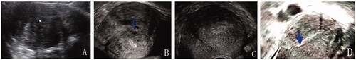 Figure 1. (A) Transabdominal sonographic image before treatment. The enlarged uterus (uterine length = 11 cm) with the adenomyosis affected the posterior uterine wall (arrow = endometrium); (B) Transvaginal sonographic image 3 months after the ablation (arrow = the secondary cystic changes); (C) Transvaginal sonographic image 6 months after the ablation. The uterine size was appropriate for the implantation of the LNG-IUS and the LNG-IUS was implanted. (D) Transvaginal sonographic image 3 years after the procedure (arrow = the bottom of the LNG-IUS). The uterus returned to its normal size.