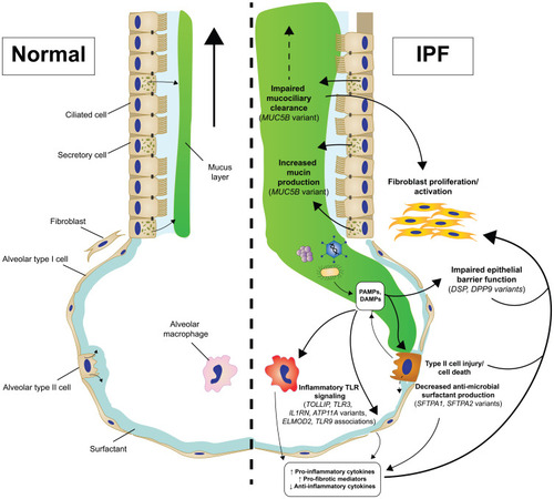 Figure 3 Genetic-driven innate immunity changes contribute to IPF pathogenesis.