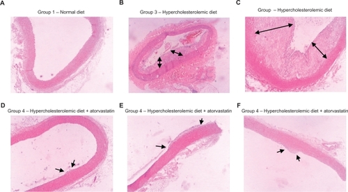 Figure 4 Histological images of arcus aorta tissues of different groups. A) Group 1, normal diet, normal epithelial and intimal lamina; B, C) Group 3, hypercholesterolemic diet and with huge atherosclerotic plaques surrounding the lumen; D–F) Group 4, hypercholesterolemic diet and atorvastatin treatment, with thin and limited atherosclerotic plaque formation.