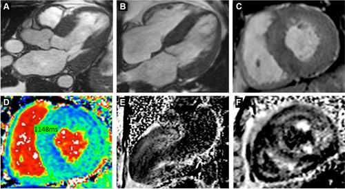 Figure 4 Contrast enhanced CMR imaging. (A–C) Cine (balanced SSFP) still frames in longitudinal 3 and 4 chambers and in short axis respectively, showing marked LV hypertrophy located predominantly at the base of the heart, with a relatively thinner apical region. (D) Native T1 map in short axis view showing high T1 time measured on 1.5 T scanner. (E, F) Late Gadolinium enhancement imaging with phase-sensitive inversion recovery reconstruction (PSIR) in longitudinal 2 chambers and short-axis views respectively, showing global subendocardial with transmural areas of myocardial hyperenhancement, with a dark blood pool.