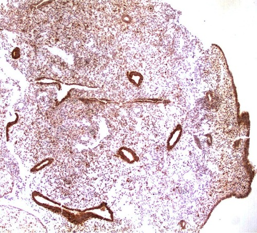 Figure 2 Cox-2 expression in the endometrial glands of a patient with idiopathic menorrhagia.