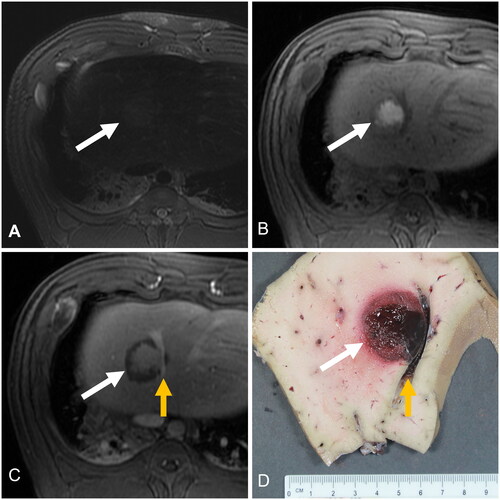 Figure 2. MRI and gross pathology images of a histotripsy treatment (white arrows) in a porcine liver. A) Axial T2-weighted fat-saturated MRI following histotripsy of a healthy swine liver. B) Axial T1 weighted MRI before the administration of IV contrast. C) Axial T1 weighted MRI after the administration of a gadolinium-based contrast, shown in the portal venous phase. A patent vessel runs through the treatment zone (yellow arrow). D) Corresponding gross pathology of histotripsy treatment with patent vessel.