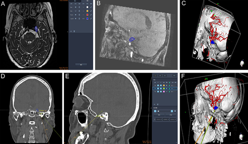 Figure 1 Surgical planning with a robotic surgical navigation workstation (A-F): (A) Delineating the shape of Meckel’s Cave on a 3D-SPACE sequence thin-slice scan; (B) The structure of Meckel’s Cave in sagittal view was similar to a “pear-shape” and can be used as a comparative reference for intraoperative balloon morphology; (C) Thin-slice CT, MRA and MRI image fusion shows the location of Meckel’s Cave and its relationship with the internal carotid artery; (D) The puncture direction of Meckel’s Cave from the foramen ovale (trajectory B). There was a certain downwards and outwards angle in the direction of the puncture path (trajectory A) from the outer skin of the corner of the mouth to the foramen ovale; (E) We measured the length of path B to plan the balloon placement depth reference; (F) shows the final three-dimensional operation plan.