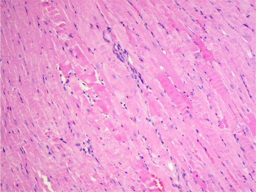 Fig. 1 Interstitial edema and inflammatory infiltration between irregular, wavy-directed cardiomyocytes (H+E; objective mag.×20; group 2DOX).