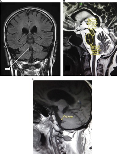 Figure 1 MRI brain images of this study in orthogonal planes showing measurement annotations and appropriate planes for measurements.