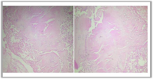 Figure 3 Section of tracheal sample showing acanthotic squamous epithelium with subepithelial deposition of pink hyaline extracellular material. Congo red stain was positive.
