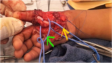 Figure 4 Vascular supply of the index finger; radial and ulnar proper digital arteries of the index (green arrow) and deep flexor of the index/FDP (yellow arrow).