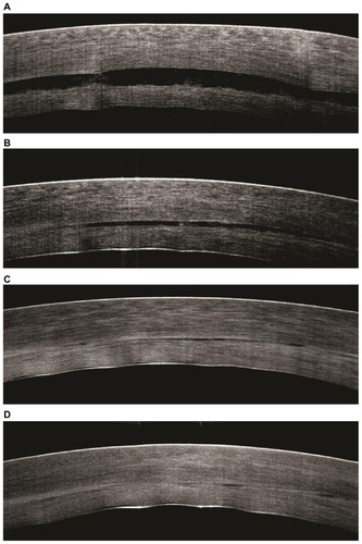 Figure 3 Intraoperative spectral-domain optical coherence tomography scans at the following surgical stages of Descemet’s stripping and automated endothelial keratoplasty. (A) After donor insertion and immediately prior to full air tamponade. (B) After air tamponade and immediately prior to the expression of fluid from the venting incisions. (C) After the expression of fluid from the venting incisions. (D) At 6 minutes of air tamponade. No interface fluid can be detected in this patient at this stage.