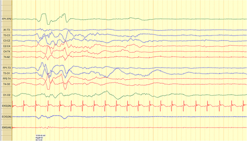 Figure 2 EEG in neonate with Hypoxic ischemic encephalopathy showing burst suppression pattern.