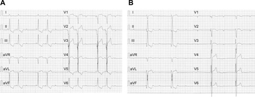 Figure 1 Electrocardiograms before and after admission.