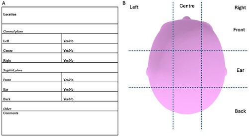 Figure 3. A, Recommended minimum reporting for characterisation of tinnitus spatial location. Characterisation could include more than one response. B, Visual aid for self-reporting on tinnitus location and clinical chart records.