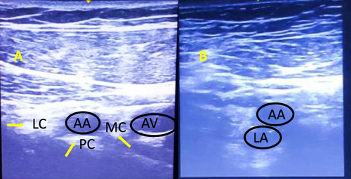 Figure 1 (A) Ultrasound image showing the infraclavicular fossa, axillary artery (AA), axillary vein (AV) and the positions of three cords for triple-point injection technique. The three brachial plexus cords are seen around the axillary artery and are marked by yellow arrows – Lateral cord (LC), Medial cord (MC), Posterior cord (PC). (B) Image showing the infraclavicular fossa with the axillary artery (AA) and the local anaesthetic (LA) as “double bubble appearance” in single-point injection technique.