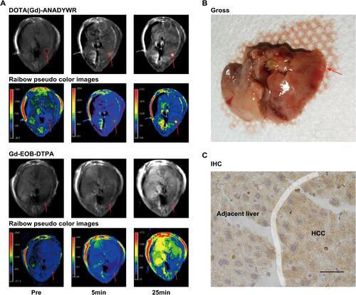 Figure 5 MR imaging with DOTA(Gd)-ANADYWR and Gd-EOB-DTPA in a DEN-induced HCC mouse. (A) Representative MR images and corresponding rainbow pseudo color images obtained before and at 5, 25 min after injection with DOTA(Gd)-ANADYWR or Gd-EOB-DTPA in a DEN-induced HCC mouse bearing an HCC lesion. (B) The corresponding gross photograph of the same lesion shown in (A) (The red arrowheads indicated the HCC. The red dotted circles indicated the visible HCC). (C) Integrin α6 expression was analyzed using immunohistochemistry IHC in tumor tissue (Scale bar, 50μm).