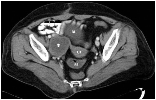 Figure 1 Axial, enhanced computed tomography image of the pelvis demonstrates a mass in the anatomic region of the right ovary, corresponding to the ovary’s schwannoma.