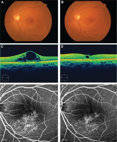 Figure 2 Images of the left eye of a 68-year-old woman with branch retinal vein occlusion (BRVO).