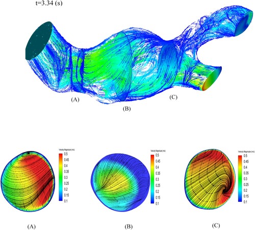 Figure 5. The streamlines of blood flow velocity with the direction of the fluid flow, at the time t=3.34[s] (the minimum of the inlet velocity). A two-dimensional plot representing streamlines along with the magnitude of blood velocity for the three regions, inlet, middle, and outlet of AAA.