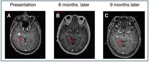 Figure 2 Brain MRI with contrast demonstrating one brain metastatic lesion (red arrows), (A) is at diagnosis, (B) following 6 months of alectinib treatment, and (C) following 9 months of alectinib.