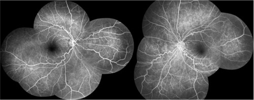 Figure 4 FFA photography of both eyes showing obviously tortuous and dilated retinal veins.
