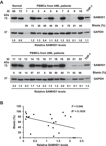 Figure 1. SAMHD1 expression negatively correlates with myeloblast levels in AML patient-derived PBMCs. (a) Five million PBMCs from 22 AML patients were collected and analyzed via immunoblotting for endogenous SAMHD1 protein. PBMCs from 2 ‘Normal’ (healthy) donors and THP-1 cells were used as a reference. GAPDH was a loading control. The percentages of blasts (%) in patient PBMCs are shown. Relative SAMHD1 levels were calculated by densitometry analysis. (b) Non-parametric correlation (Spearman) analysis between relative SAMHD1 levels and blast percentages (P = 0.046, R2 = 0.1935). Patient #1 sample was excluded from analysis due to low protein concentration of the cell lysate.