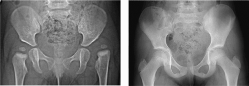 Figure 2. Patient no. 1 at 8 months. Left hip dislocated.  Patient no. 1 at 9 years of age. Left hip normal.