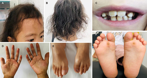 Figure 1 Clinical manifestations of our Carvajal syndrome patient with novel variants in the desmoplakin (DSP) gene. (A and B) Sparse, dark-brown, and woolly hair; (C) Oligodontia and odontoloxia; (D) Palmoplantar keratoderma (PPK) on both palms; (E and F) PPK on both toes and soles.