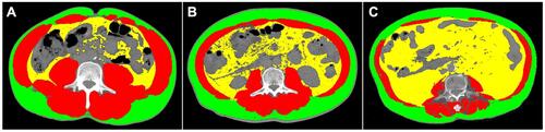 Figure 1 Computed tomographic scans showing areas of body composition in AP patients with different severities. (A–C) Show mild, moderately severe, and severe AP, respectively. Skeletal muscle is represented in red, visceral adipose tissue is represented in yellow, and subcutaneous adipose tissue is represented in green. At a similar BMI, as the severity of AP increased, VAT also increased gradually (54.01 cm2, 135.8 cm2 and 372.4 cm2). In contrast, SMA showed a decreasing trend (52.41 HU, 37.08 HU and 18.99 HU).